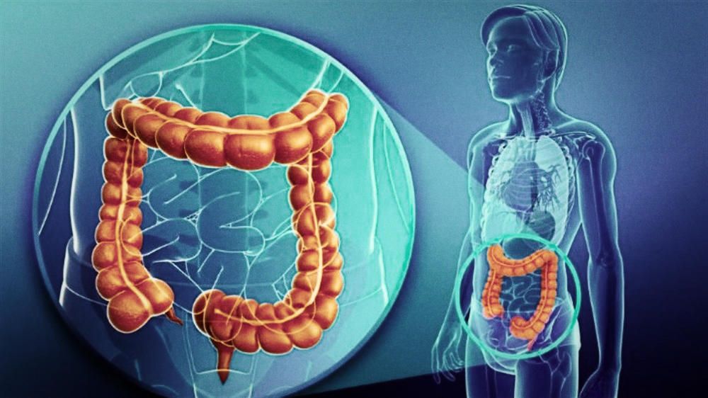 Estados Unidos: Cáncer de colon.